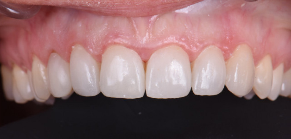 Microcarillas dentales: la clave para renovar sonrisa