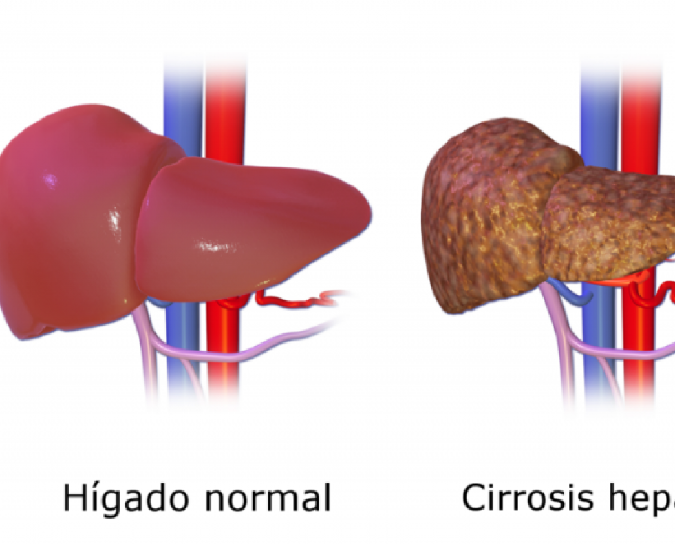 Cirrosis