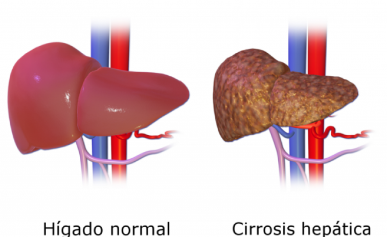 Reducir la fragilidad en la cirrosis: ejercicio en casa, aminoácidos y probióticos