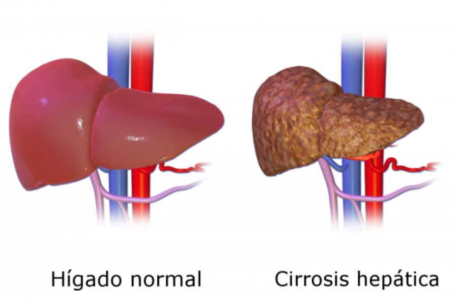 Reducir la fragilidad en la cirrosis: ejercicio en casa, aminoácidos y probióticos